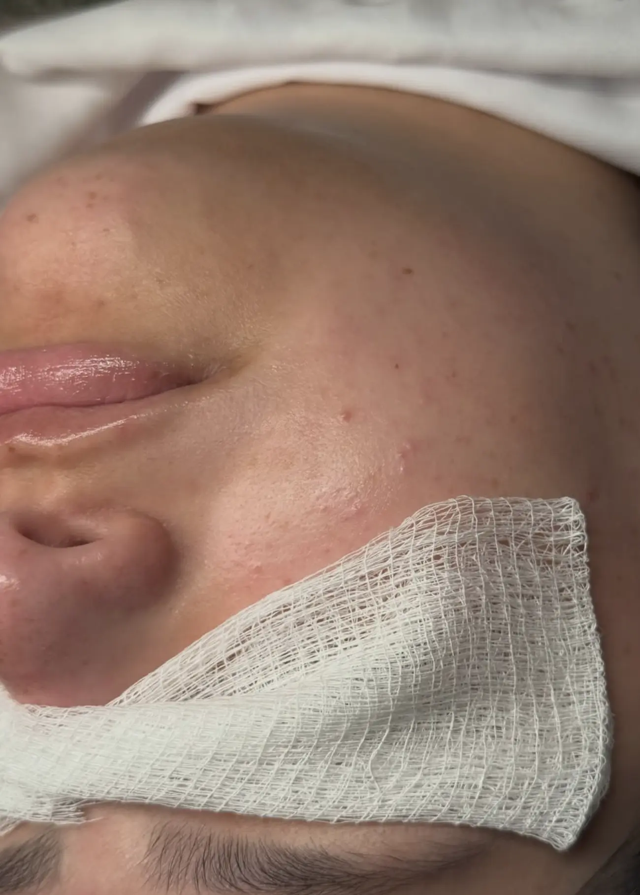 accredited dermaplaning course