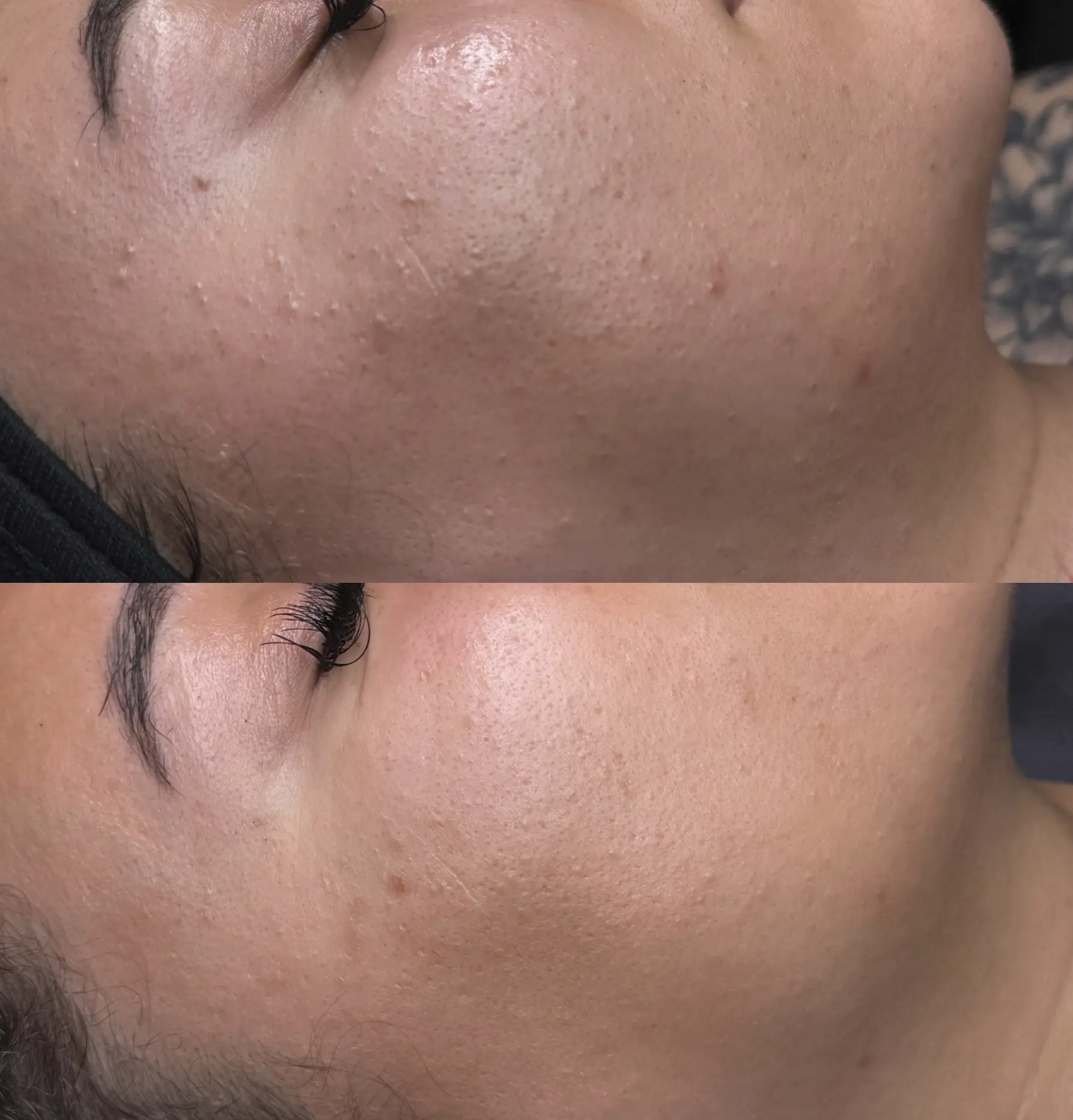dermaplaning and chemical peel course